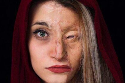 فاواپرس - پس از حمله اسیدپاشی چه کارهایی باید انجام دهیم؟